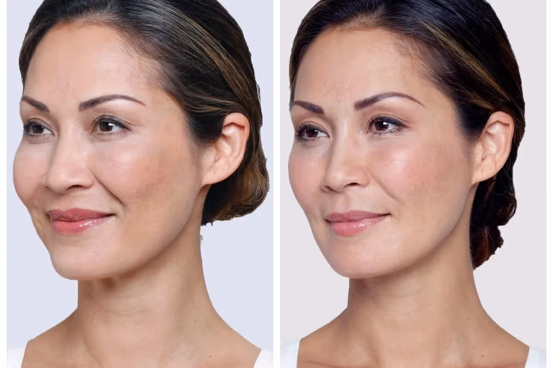 Before and after cosmetic procedure results at MDW Aesthetics Miami in Brickell